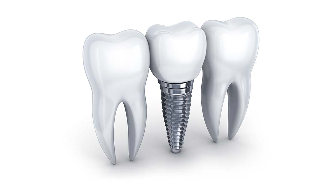 Single implant image