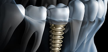 Dental Implants Image